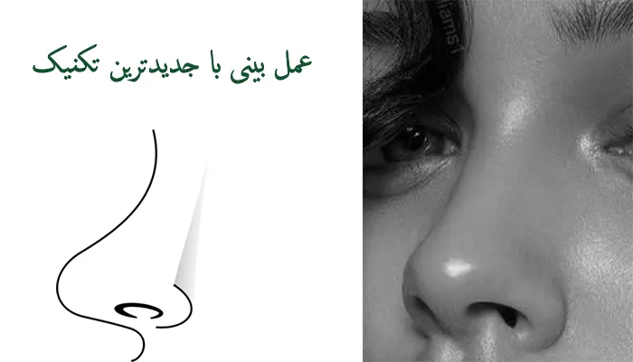 جراحی بینی