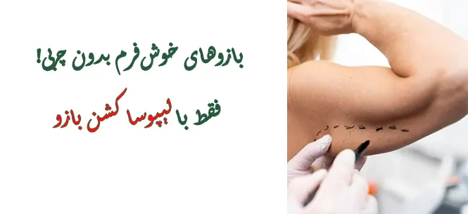 لیپوساکشن بازو