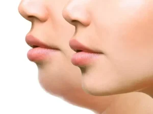 برداشتن چربی غبغب