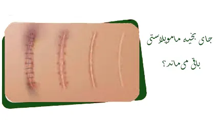 جای بخیه های ماموپلاستی