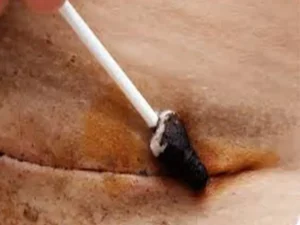 زخم بخیه ماموپلاستی