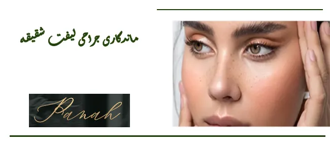 ماندگاری عمل لیفت شقیقه