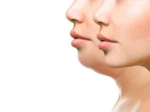 عمل پروتز چانه