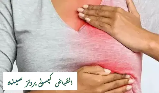 انقباض کپسولی پروتز سینه