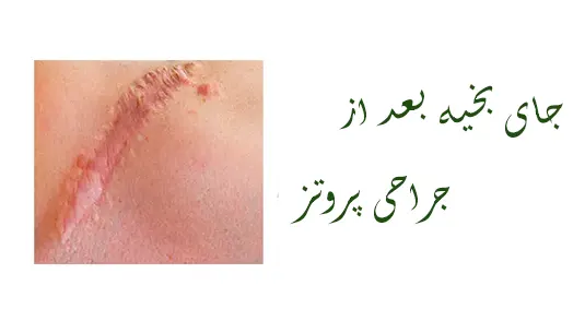 جای بخیه بعد از عمل پروتز