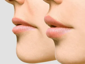 جراحی لیفت سانترال لب