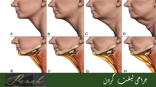 جراحی لیفت گردن