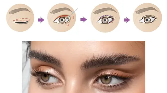 جراحی چشم گربه ای