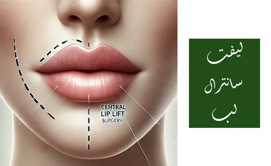 لیفت سانترال لب