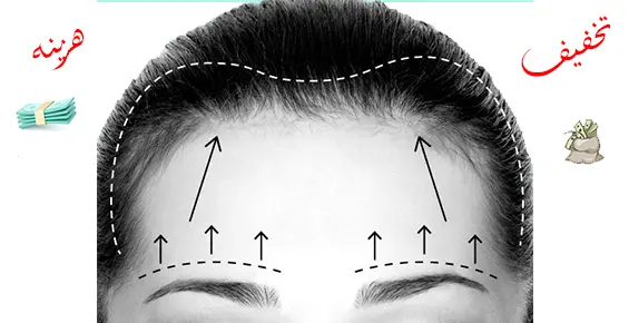هزینه عمل لیفت شقیقه هزینه عمل لیفت شقیقه