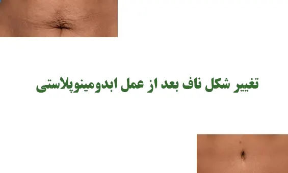 تغییر شکل ناف بعد از عمل ابدومینوپلاستی تغییر شکل ناف بعد از عمل ابدومینوپلاستی