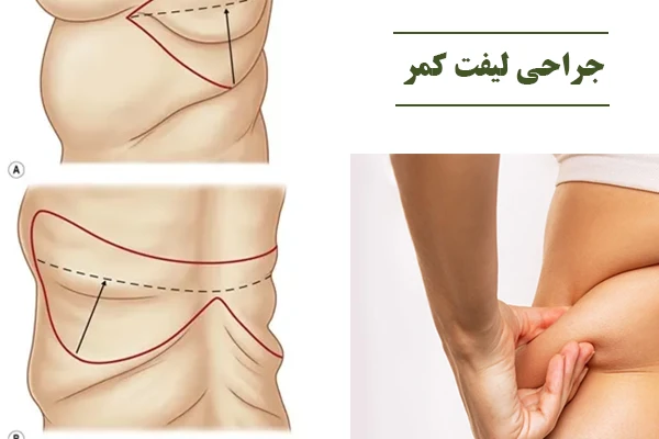 جراحی لیفت کمر