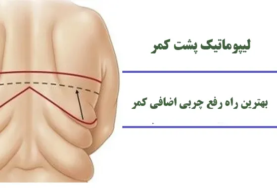عمل لیپوماتیک پشت کمر