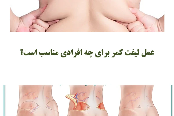 کاندیدای مناسب لیفت کمر