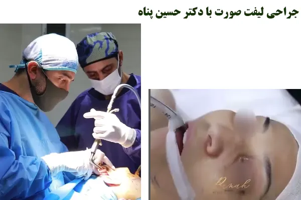 جراحی لیفت صورت با دکتر حسین پناه