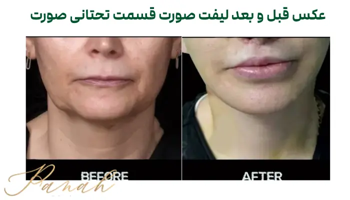 عکس قبل و بعد لیفت صورت قسمت تحتانی صورت عکس قبل و بعد لیفت صورت قسمت تحتانی صورت